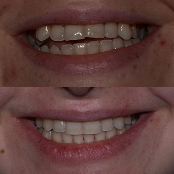 Invisalign with cosmetic recontouring