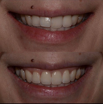 Invisalign with cosmetic recontouring