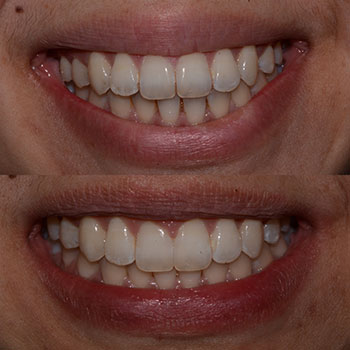 Invisalign with cosmetic recontouring