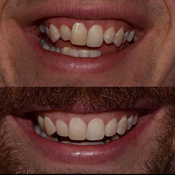 Invisalign with cosmetic recontouring