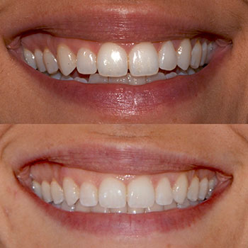 Invisalign with cosmetic recontouring