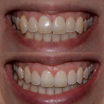 Invisalign with Cosmetic recontouring