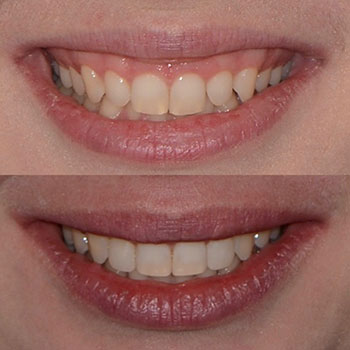 Invisalign with cosmetic bonding