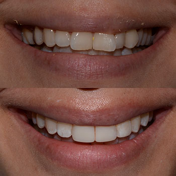 Invisalign with cosmetic recontouring