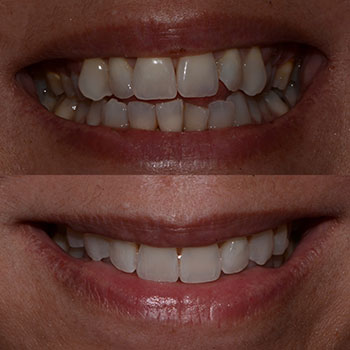 Invisalign with cosmetic recontouring