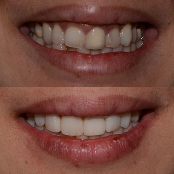 Invisalign, crown for right central incisor, cosmetic bonding and recontouring