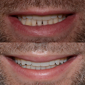 Invisalign with cosmetic bonding