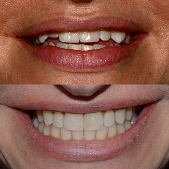 Invisalign with cosmetic bonding