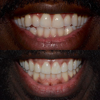 Invisalign with cosmetic recontouring