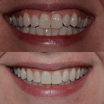 Invisalign with cosmetic recontouring